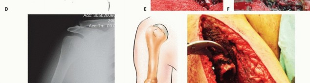 Illustration 20 for Restore Vital Function: Surgery for Type II Humeral Metastasis