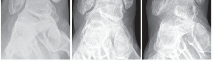 Illustration 6 for Medial Ankle Instability: Find Relief with Reconstruction