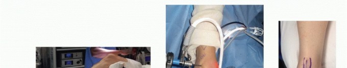 Microfracture for OLTs: Restore a rim of stable, healthy bone & cartilage.