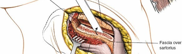 Illustration 29 for Pelvis & Acetabulum Approaches: Unlocking the Posterior Superior Iliac
