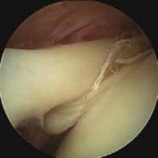 Illustration 5 for Resolve Long Head Biceps Pain: Advanced Arthroscopic Treatment