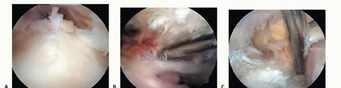 Arthroscopic Release of Nerve: Find Lasting Relief from Entrapment