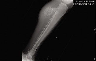 Leg Pain & Masses: Uncover Oncology Cases of Osteochondroma