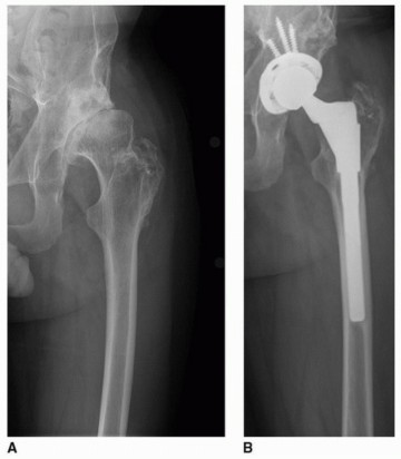 Illustration 6 for Overcoming Proximal Femoral Deformity in THA: Key Strategies