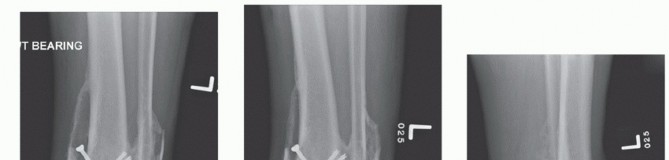Illustration 33 for Optimize Pain Management with Proximal Ring Block for Ankle Arthrodesis