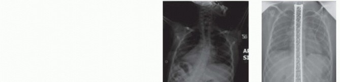 Illustration 26 for Duchenne Muscular Dystrophy: Is Spinal Fusion the Answer?