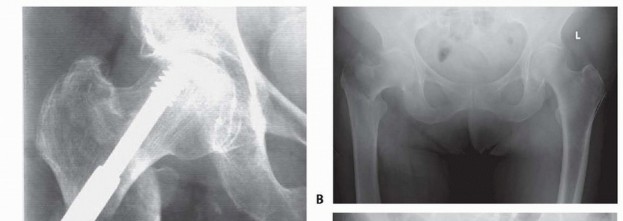 Illustration 24 for ORIF for Peritrochanteric Hip Fractures: Achieve Stable Mobility