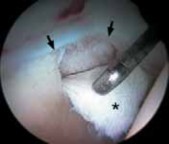 Illustration 35 for Solving Hip Soft Tissue Pathology with Advanced Arthroscopy