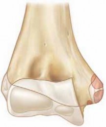 ORIF for Medial Epicondyle Fractures: Restoring Full Range of Motion