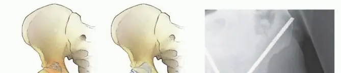 استعادة الحركة بعد سرطان الورك: جراحة استبدال مفصل الورك الكلي للآفات الخبيثة مع الأستاذ الدكتور محمد هطيف في صنعاء