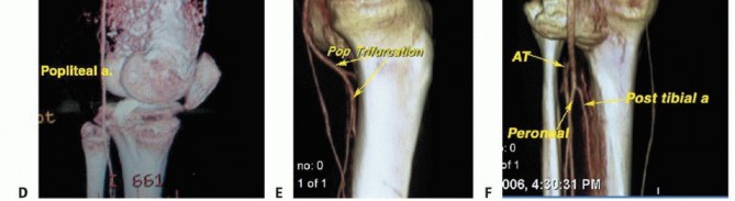 Illustration 18 for Advanced Distal Femoral Resections: Limb-Sparing Outcomes & Techniques
