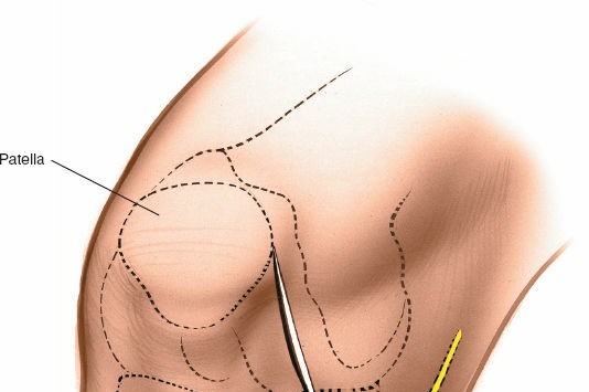 Illustration 47 for Mastering Knee Approaches: Spotlight on Superficial Medial Ligament