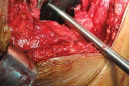 Illustration 25 for Optimizing Arthroplasty in Acute Fractures: Octopus System