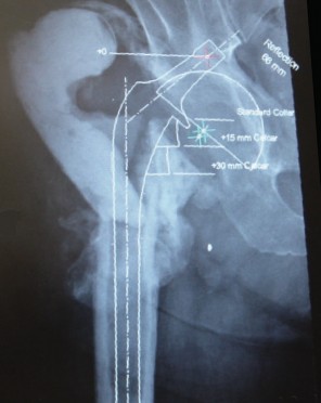Illustration 9 for Templating for Revision: Navigate Complex Hip Arthroplasty