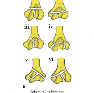 Illustration 4 for Mastering Distal Humerus Fractures: Diagnosis & Treatment