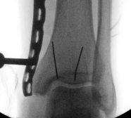 Illustration 24 for Tibial Fracture Extending into the Plafond: Intramedullary Secrets