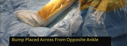 Illustration 4 for Minimal Incision Total Knee: Experience Faster Healing