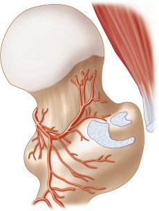 Illustration 19 for Figure Hip Resurfacing: Who Benefits and Who Should Avoid It?
