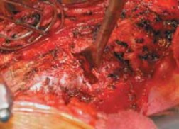 Illustration 41 for Mastering Anterior Interbody Arthrodesis with Instrumentation for Scoliosis