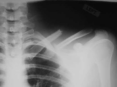 Illustration 138 for OrthoCash: Trauma MCQs & Cases for a yearold woman