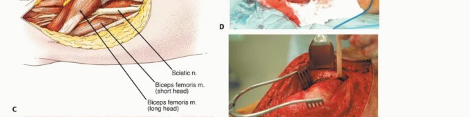 Illustration 13 for Posterior Thigh Resection: Rethinking Outcomes & Limb Sparing