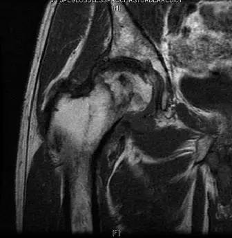 صورة توضيحية لـ النخر اللاوعائي المتقدم لرأس الفخذ: دليل شامل للعلاج واستبدال مفصل الورك مع الأستاذ الدكتور محمد هطيف في صنعاء