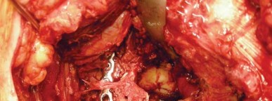 Illustration 46 for Navigating Early THA for Fractures of the Acetabulum