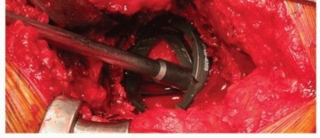 Illustration 23 for Uncemented Acetabular Revision: Optimizing Hemispherical Cup Use