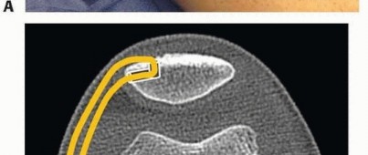 Illustration 13 for Chronic Patellar Instability: From Acute Onset to Lasting Solutions