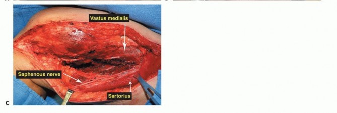 Illustration 34 for Advanced Distal Femoral Resections: Limb-Sparing Outcomes & Techniques