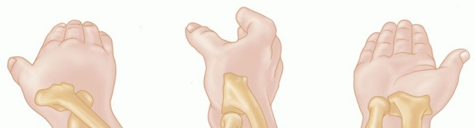 Radial Head & Neck Fractures: Mastering ORIF for Best Results
