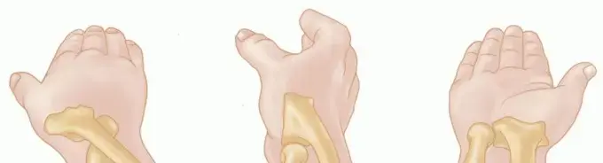 كسور رأس وعنق الكعبرة: دليل شامل للعلاج والتعافي مع الأستاذ الدكتور محمد هطيف