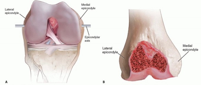 Illustration 22 for Correcting Stiffness in Revision TKA: Achieve Appropriate External Rotation