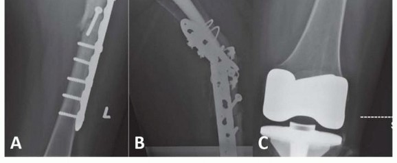 Illustration 30 for Mastering Fixation of Periprosthetic Fractures of the Femur