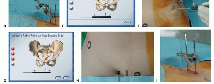 Illustration 20 for Hip Resurfacing: The Bone-Sparing Solution around the Femoral Head