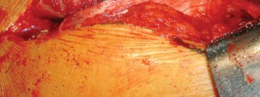 Illustration 58 for S-ROM: Inside the Technique of Modular Implant Design