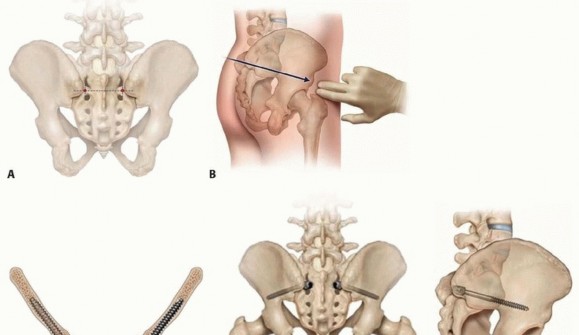 Illustration 15 for Duchenne Muscular Dystrophy: Is Spinal Fusion the Answer?