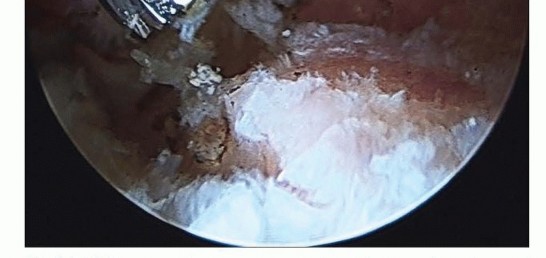 Illustration 31 for Hip Arthroscopy: Your Minimally Invasive Solution for Hip Pain