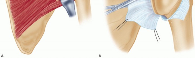 Illustration 17 for Finally Treat Recurrent Posterior Instability of the Shoulder