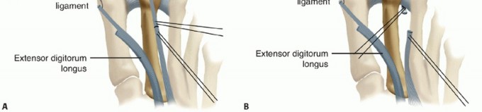 Illustration 9 for Toe Deformity Pain? Rebalance Flexor to Extensor for Relief