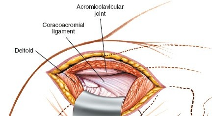 Illustration 93 for Essential Guide: Mastering Every Approach to the Shoulder