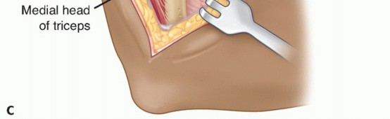 Illustration 26 for Surgical Approaches to Shoulder & Elbow: Pearls and Pitfalls