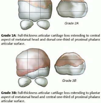 Illustration 10 for End Articular Cartilage Loss: Arthrosurface HemiCAP Resurfacing