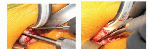 Illustration 31 for Anterior FAI Relief: Mini-Open Anterior Approach Explained