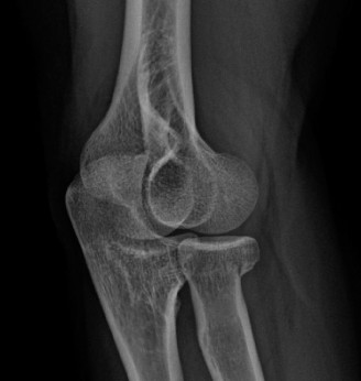 Stiff Elbow Cases: Diagnosing & Treating Post-Traumatic Contractures
