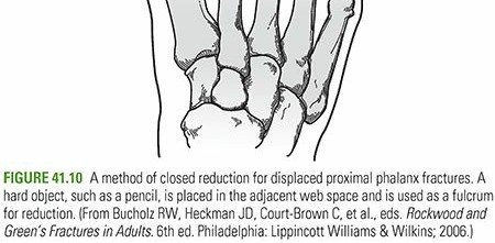 Illustration 26 for Mastering First MTP Joint & Forefoot Fractures: A Comprehensive Guide