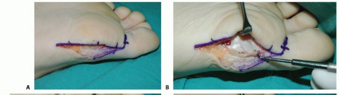 Illustration 17 for Optimizing Internal Fixation of Sesamoid Fractures