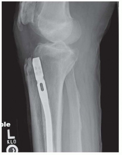 Illustration 25 for Optimizing Intramedullary Nailing for Tibial Shaft Fractures
