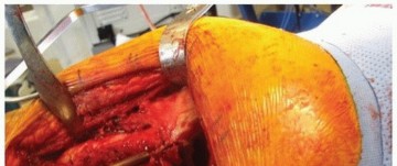 Illustration 11 for Extended Trochanteric Osteotomy: How et al Extended Revision THA Solutions