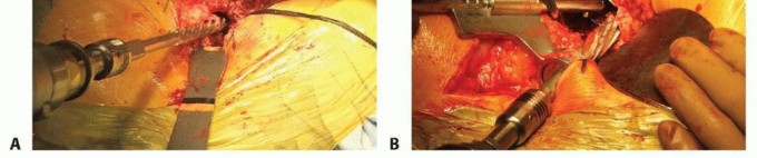 Illustration 4 for Overcoming Proximal Femoral Bone Loss: Fluted Stems in Revision THA